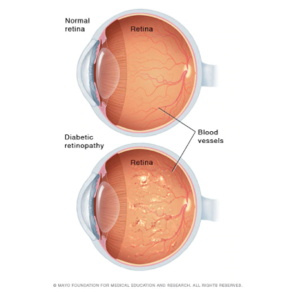 How Diabetes Can Lead to Vision Loss - DIABETIC EYE MEDICAL CLINIC